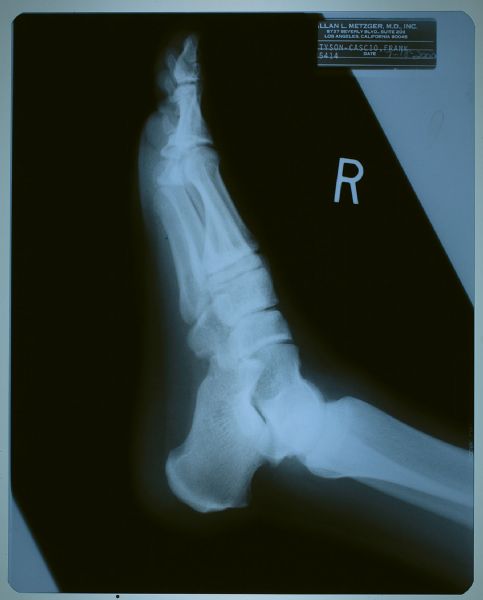 Michael Jackson’s Foot X-Rays