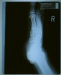 Michael Jackson’s Foot X-Rays