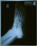 Michael Jackson’s Foot X-Rays