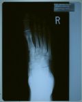 Michael Jackson’s Foot X-Rays